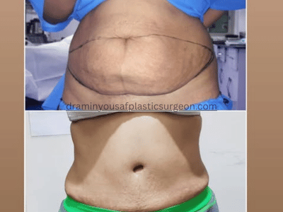 tummy tuck (1)