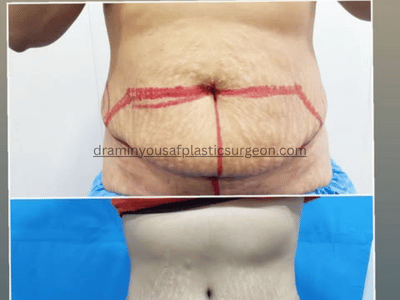 tummy tuck (2)
