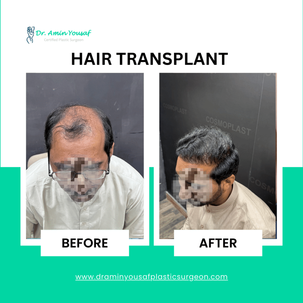 hair-transplant-lahore