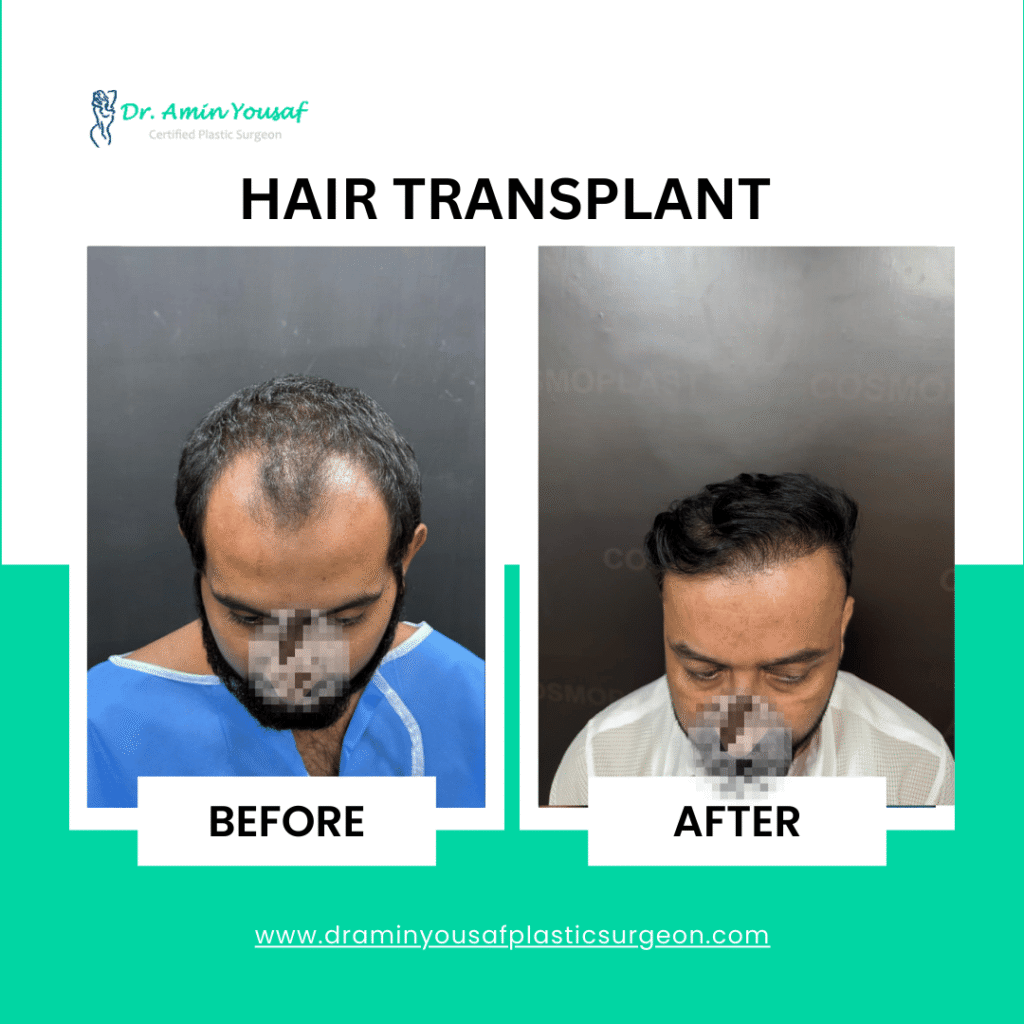 hair-transplant-lahore