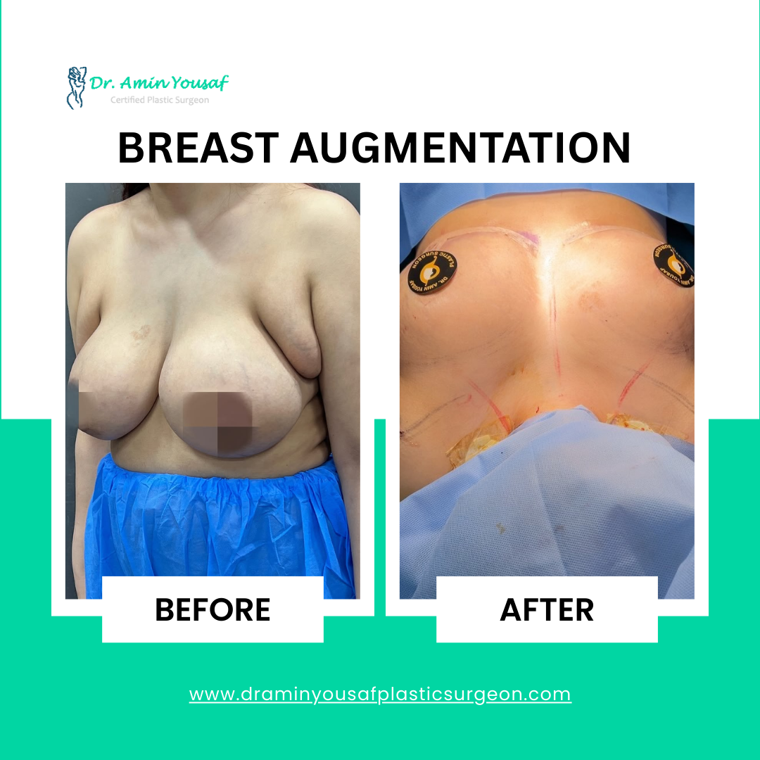 breast-augmentation-with-implant2