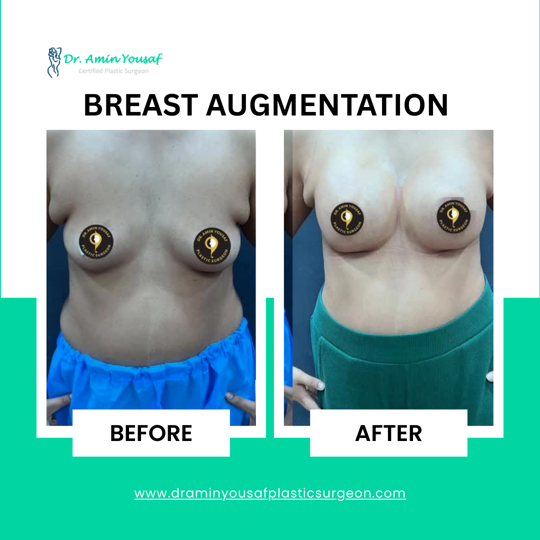breast-augmentation-with-implant