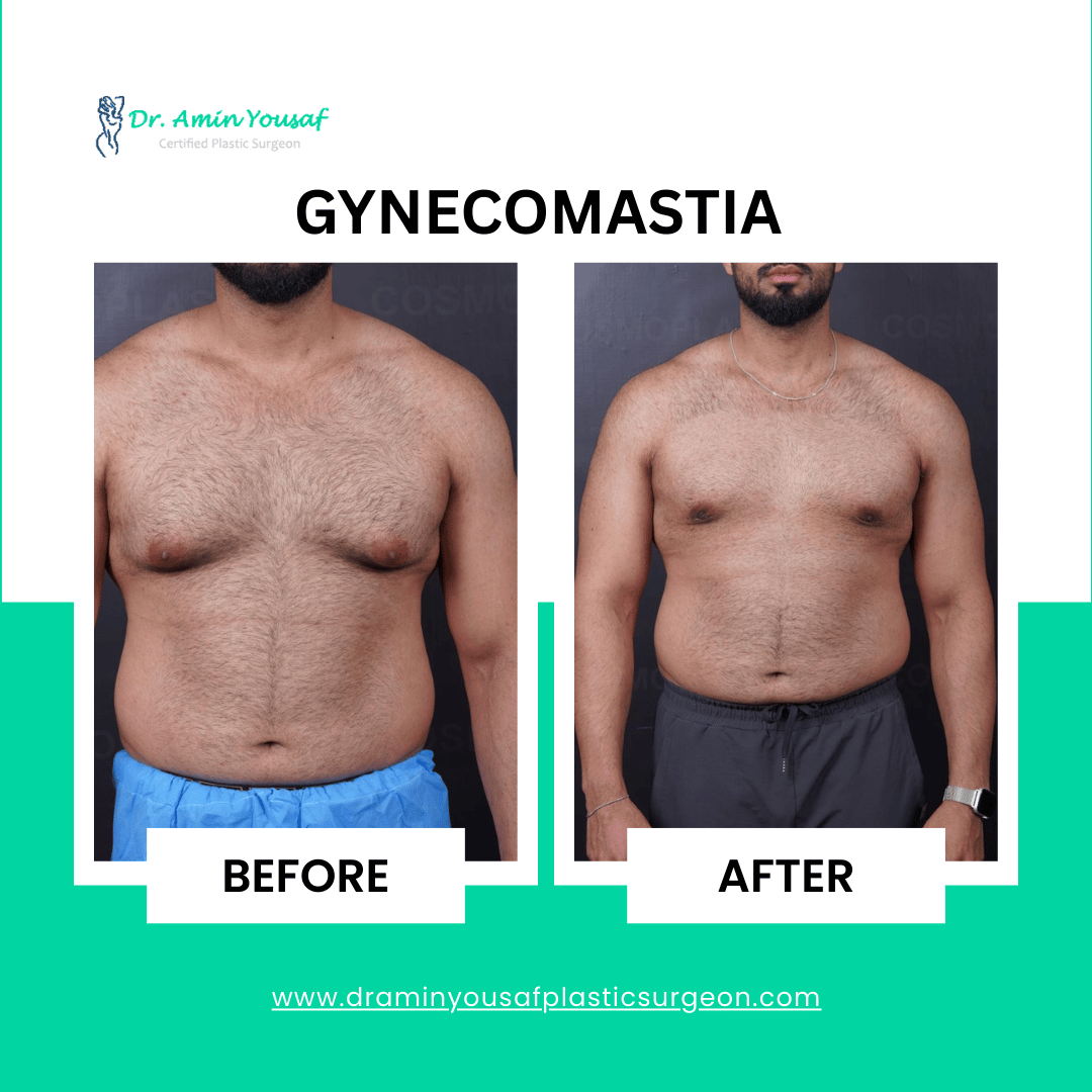 gynecomastia