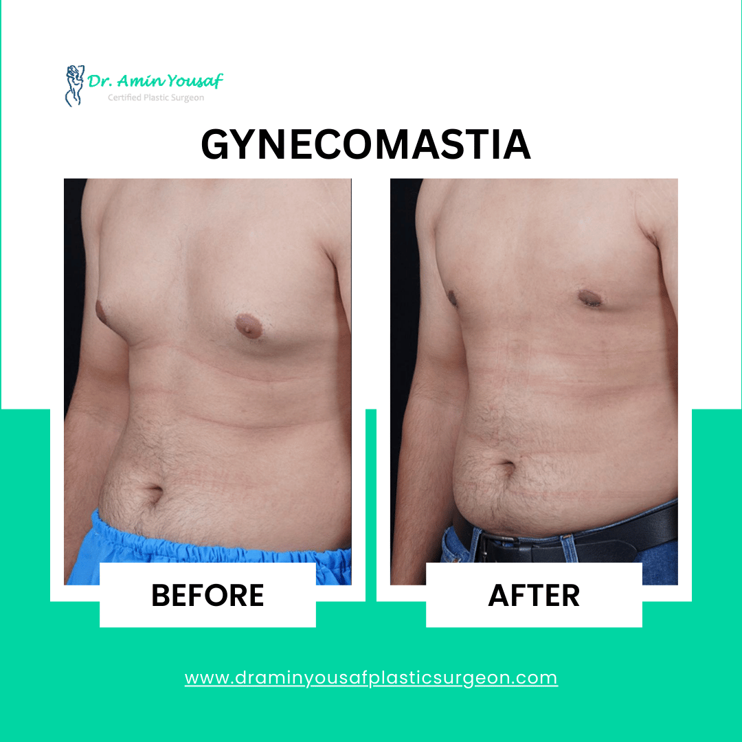 gynecomastia surgery
