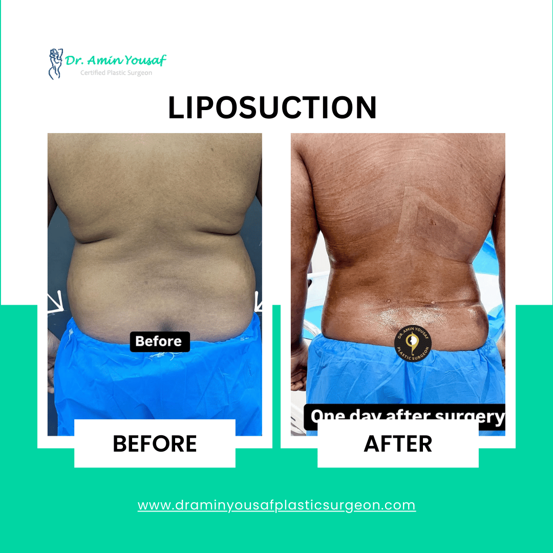 liposuction-in-lahore-photo3
