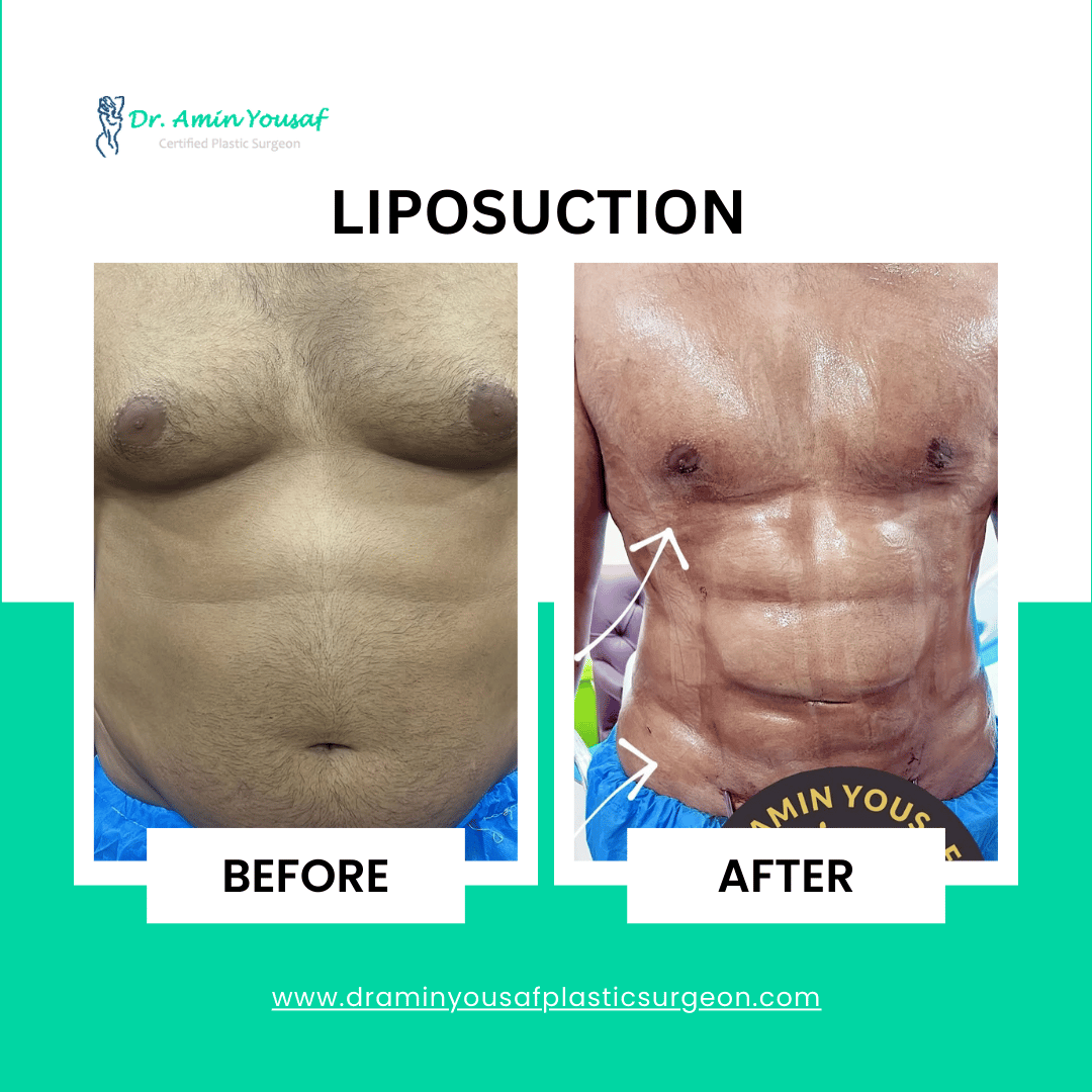 liposuction-in-lahore-photo2