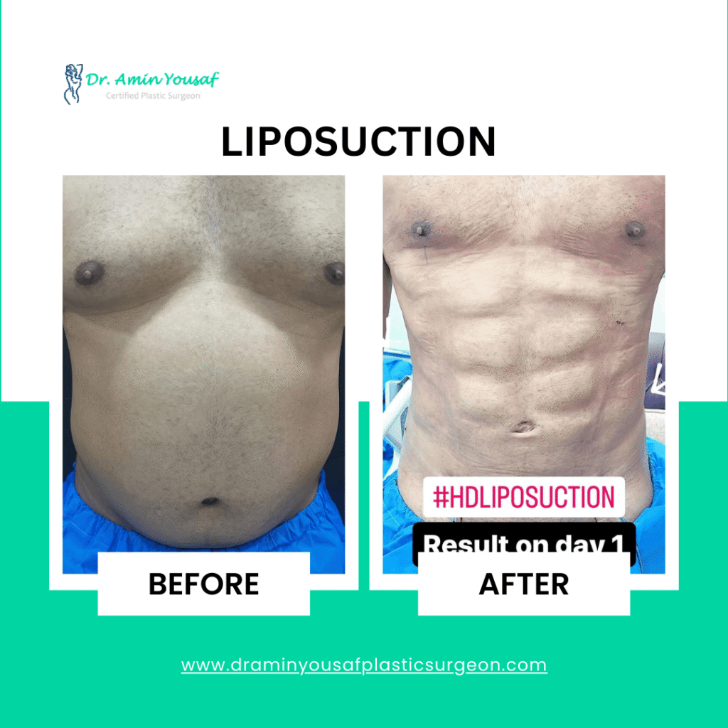 liposuction-in-lahore-photo