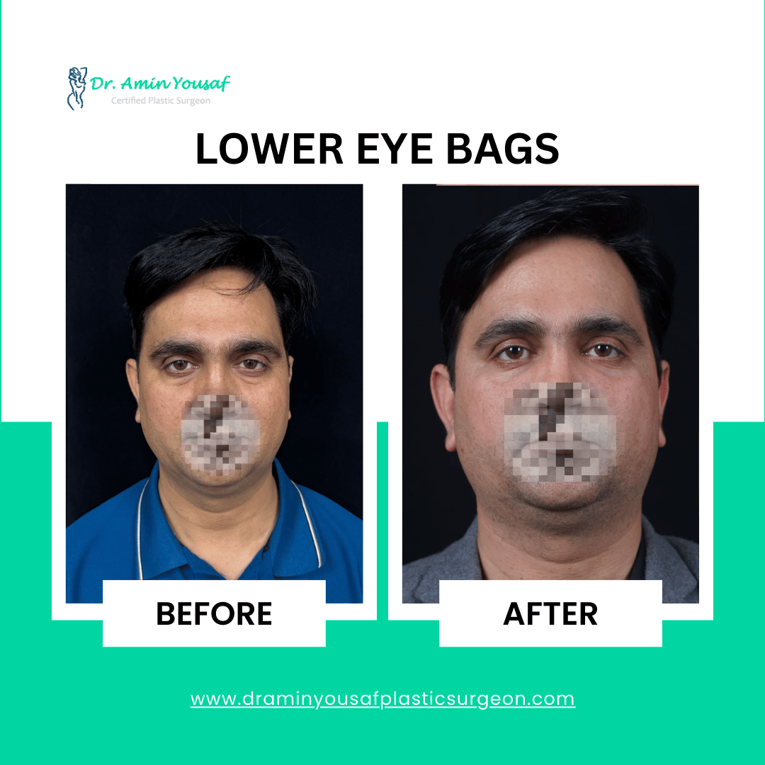 lower-eyebags-surgery