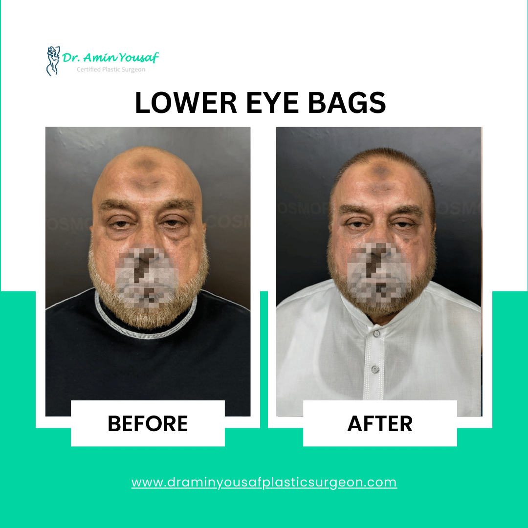 eyelid-surgery-lower-eyebags