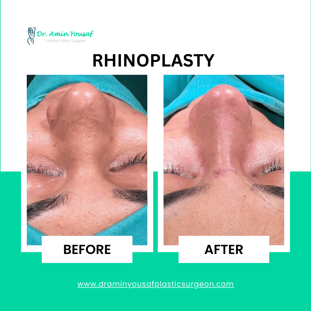 nose-job-rhinoplasty
