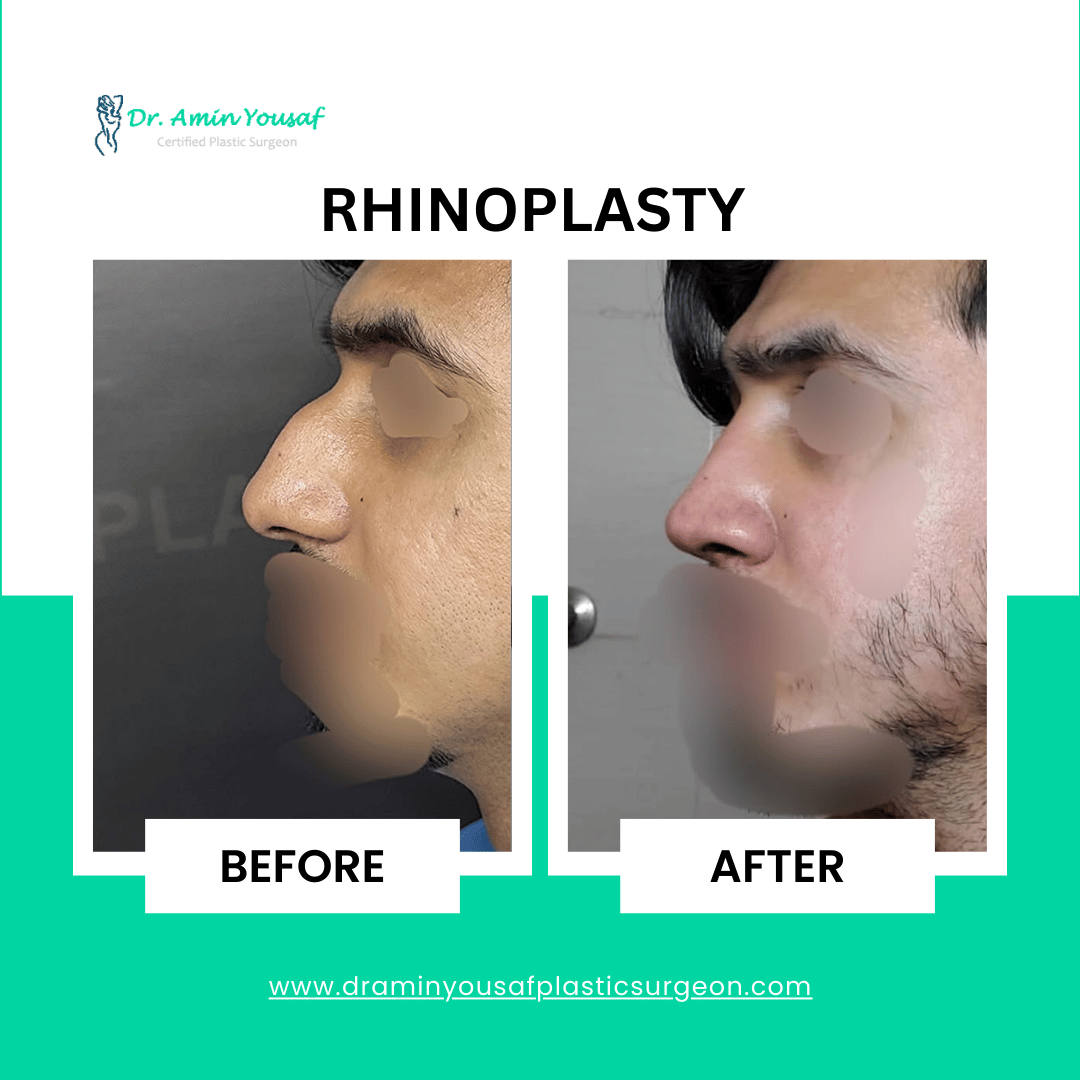 rhinoplasty-nose-reshaping