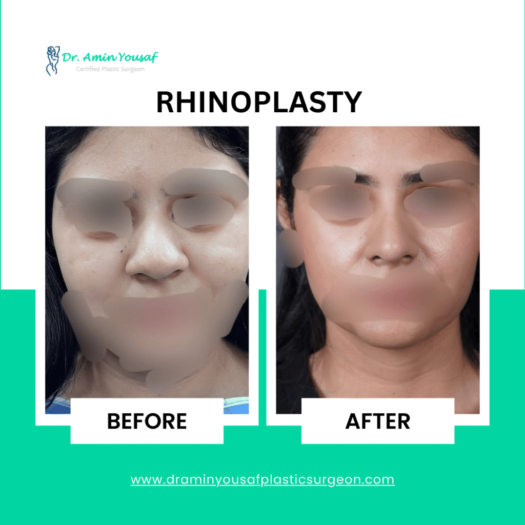 rhinoplasty-in-lahore