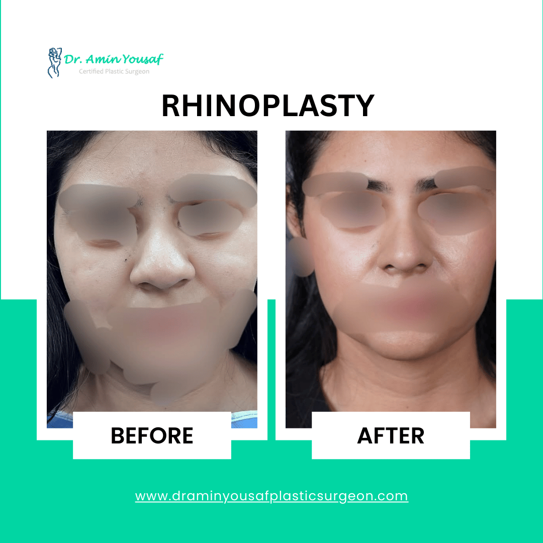 rhinoplasty-in-lahore