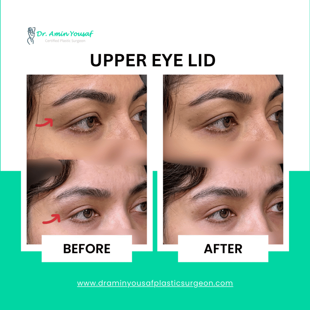 upper-eye-lid-surgery