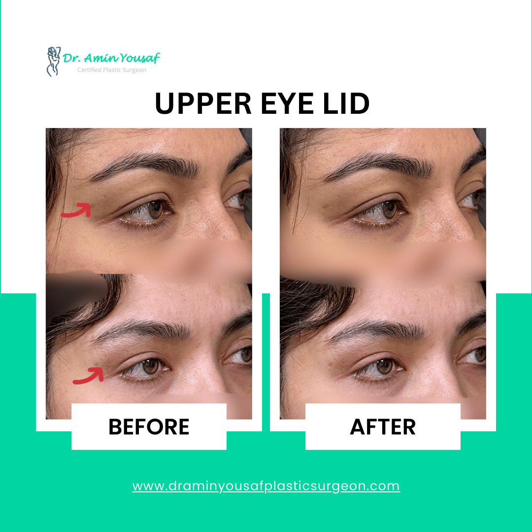 upper-eye-lid-surgery